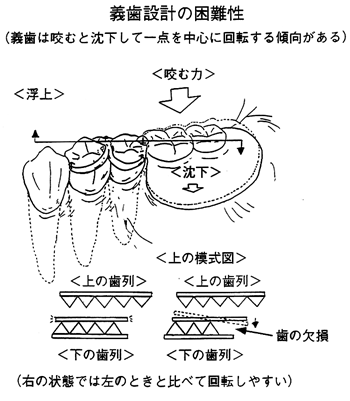 義歯設計の困難性 1