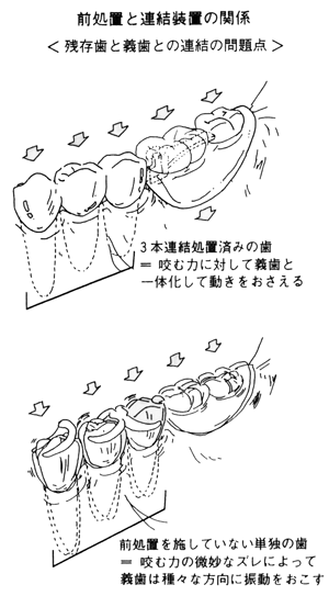 前処理と連結装置の関係