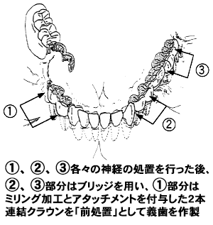 治療例３