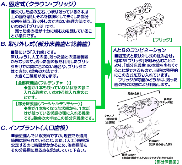 義歯の構造と維持装置